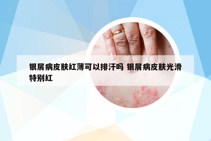 銀屑病皮膚紅薄可以排汗嗎 銀屑病皮膚光滑特別紅