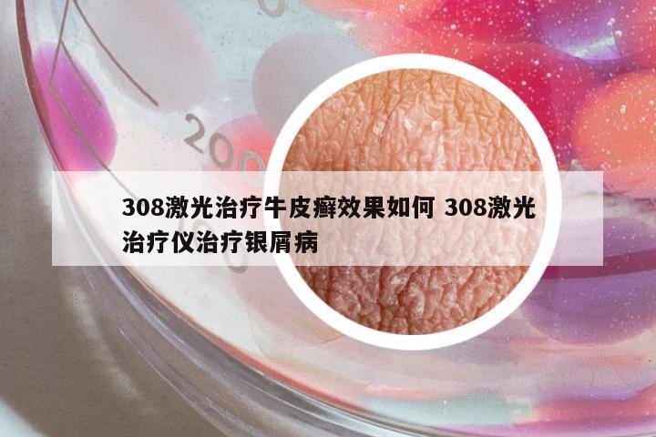 308激光治療牛皮癬效果如何 308激光治療儀治療銀屑病