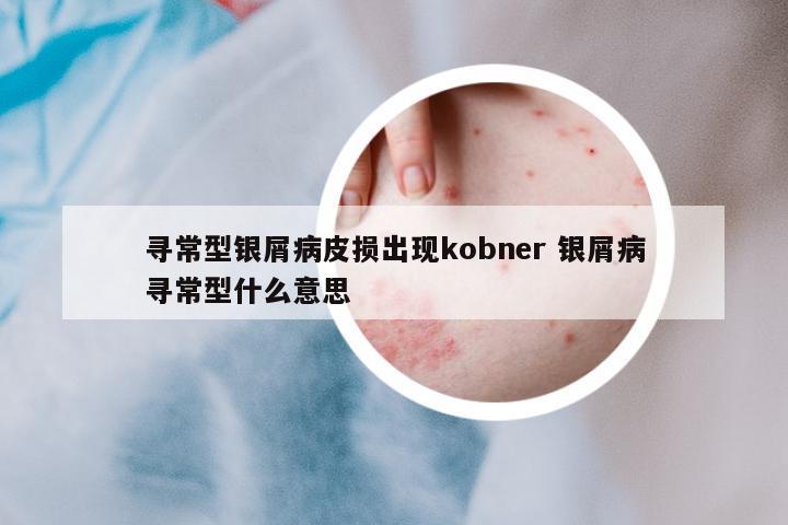 尋常型銀屑病皮損出現(xiàn)kobner 銀屑病尋常型什么意思