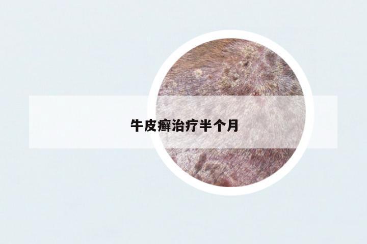 牛皮癬治療半個(gè)月