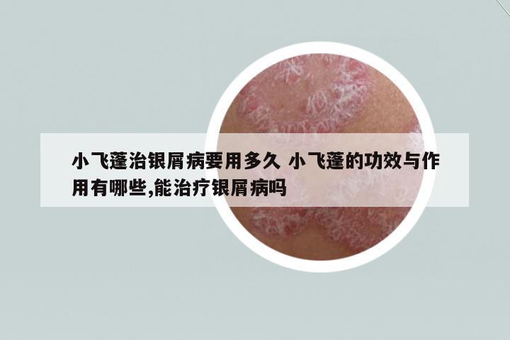 小飛蓬治銀屑病要用多久 小飛蓬的功效與作用有哪些,能治療銀屑病嗎