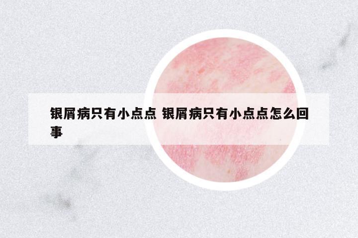 銀屑病只有小點(diǎn)點(diǎn) 銀屑病只有小點(diǎn)點(diǎn)怎么回事