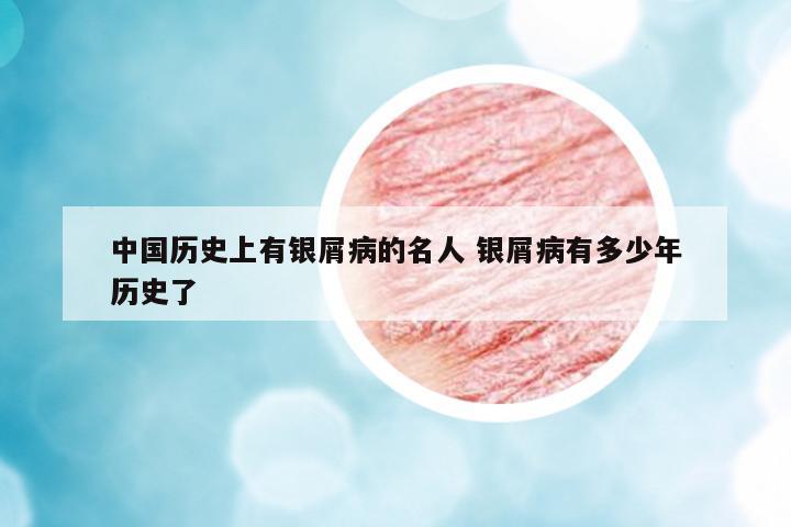 中國歷史上有銀屑病的名人 銀屑病有多少年歷史了