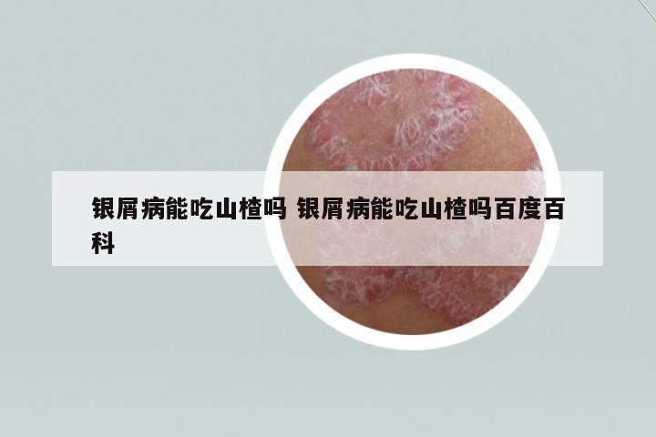 銀屑病能吃山楂嗎 銀屑病能吃山楂嗎百度百科
