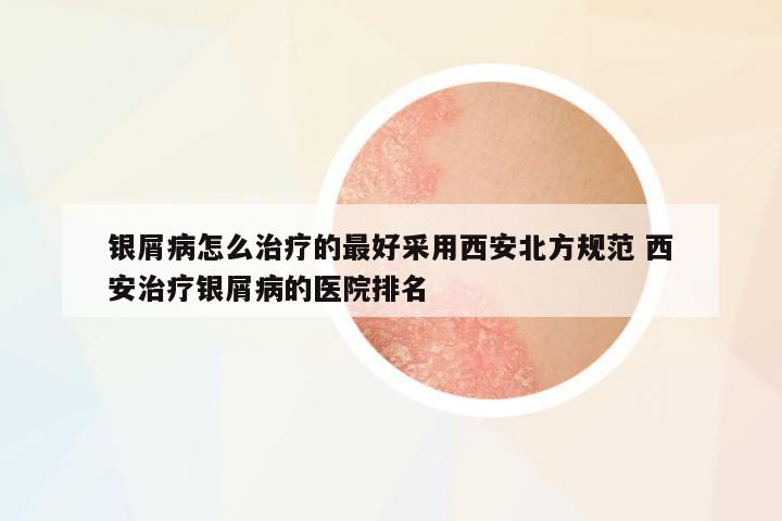 銀屑病怎么治療的最好采用西安北方規(guī)范 西安治療銀屑病的醫(yī)院排名