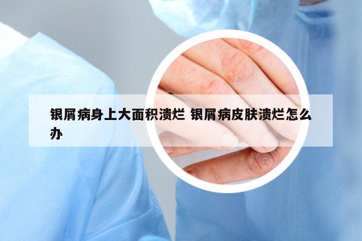銀屑病身上大面積潰爛 銀屑病皮膚潰爛怎么辦