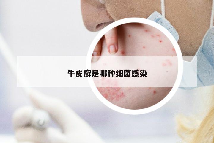 牛皮癬是哪種細(xì)菌感染