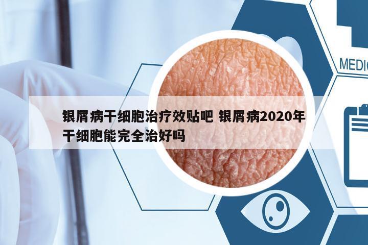 銀屑病干細(xì)胞治療效貼吧 銀屑病2020年干細(xì)胞能完全治好嗎
