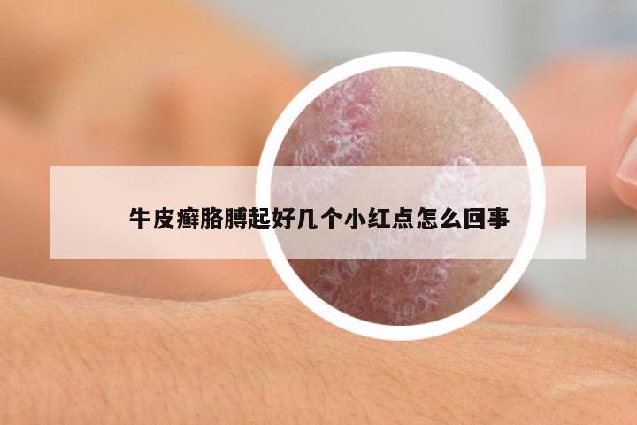 牛皮癬胳膊起好幾個小紅點怎么回事