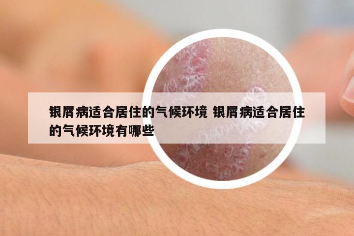 銀屑病適合居住的氣候環(huán)境 銀屑病適合居住的氣候環(huán)境有哪些