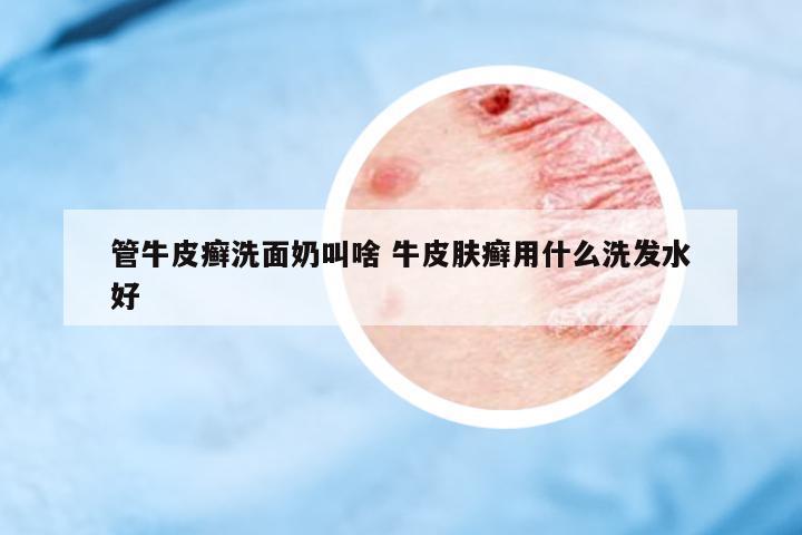 管牛皮癬洗面奶叫啥 牛皮膚癬用什么洗發(fā)水好