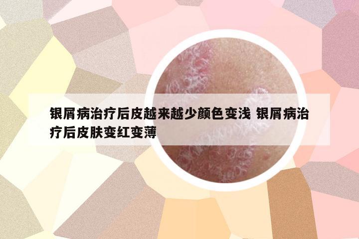 銀屑病治療后皮越來(lái)越少顏色變淺 銀屑病治療后皮膚變紅變薄