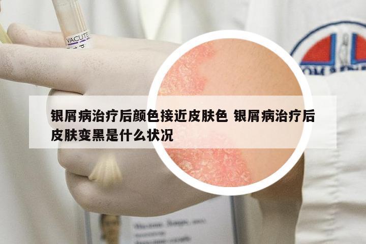銀屑病治療后顏色接近皮膚色 銀屑病治療后皮膚變黑是什么狀況