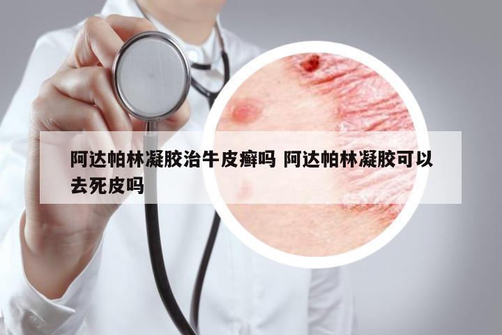 阿達帕林凝膠治牛皮癬嗎 阿達帕林凝膠可以去死皮嗎