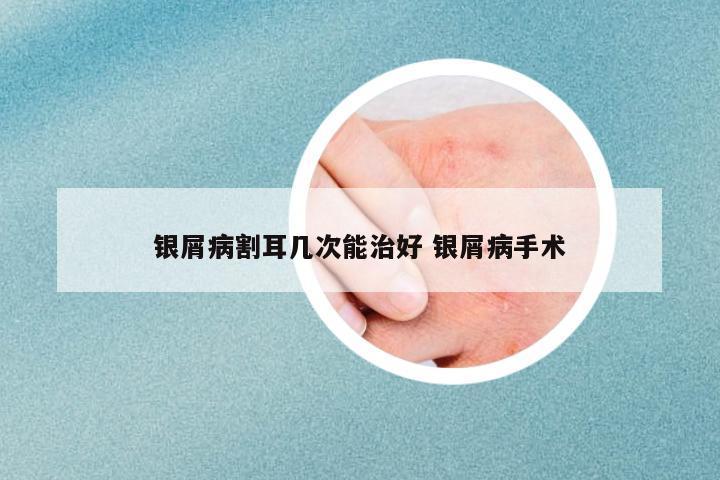 銀屑病割耳幾次能治好 銀屑病手術(shù)
