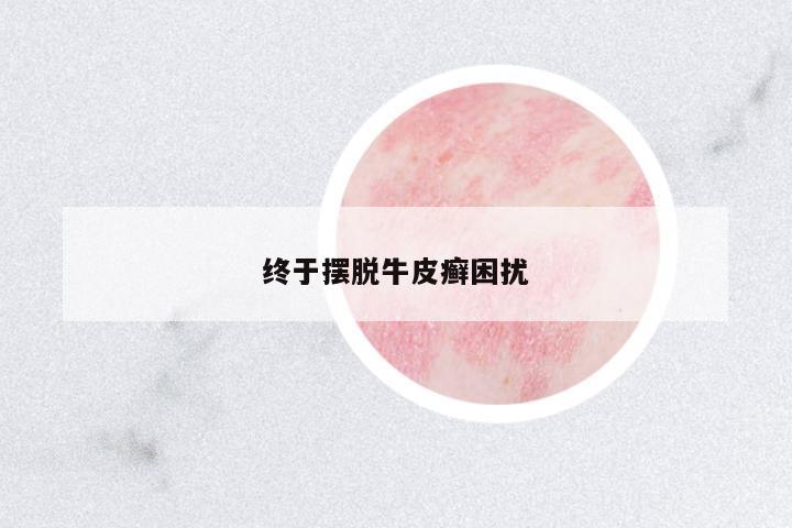 終于擺脫牛皮癬困擾