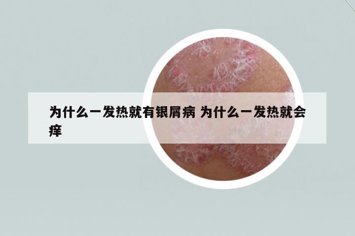 為什么一發(fā)熱就有銀屑病 為什么一發(fā)熱就會癢