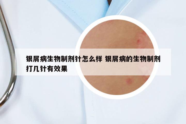 銀屑病生物制劑針怎么樣 銀屑病的生物制劑打幾針有效果