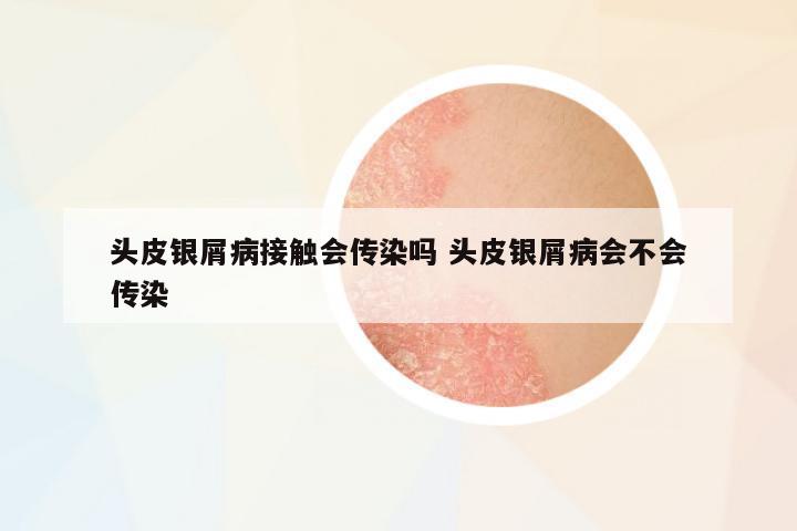 頭皮銀屑病接觸會(huì)傳染嗎 頭皮銀屑病會(huì)不會(huì)傳染