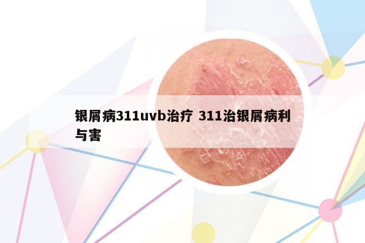 銀屑病311uvb治療 311治銀屑病利與害