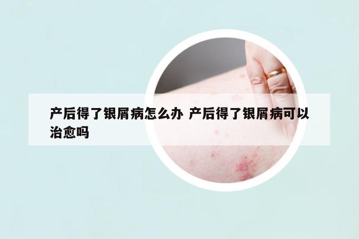 產(chǎn)后得了銀屑病怎么辦 產(chǎn)后得了銀屑病可以治愈嗎