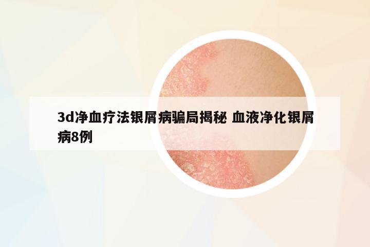 3d凈血療法銀屑病騙局揭秘 血液凈化銀屑病8例