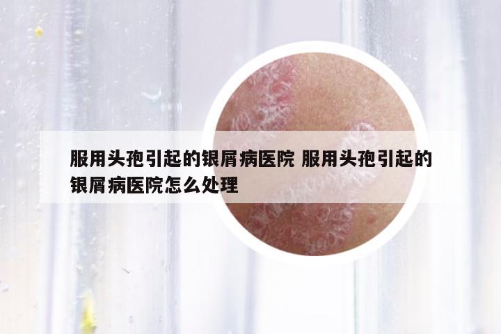 服用頭孢引起的銀屑病醫(yī)院 服用頭孢引起的銀屑病醫(yī)院怎么處理