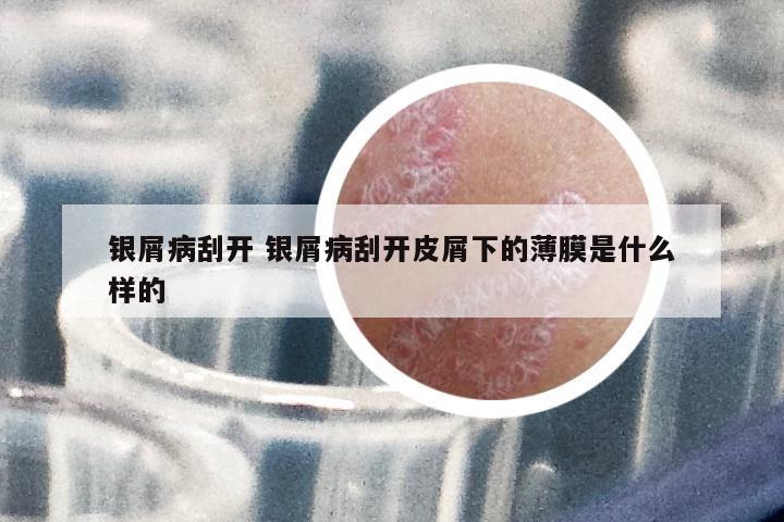 銀屑病刮開 銀屑病刮開皮屑下的薄膜是什么樣的
