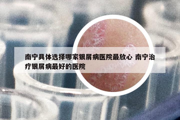 南寧具體選擇哪家銀屑病醫(yī)院最放心 南寧治療銀屑病最好的醫(yī)院