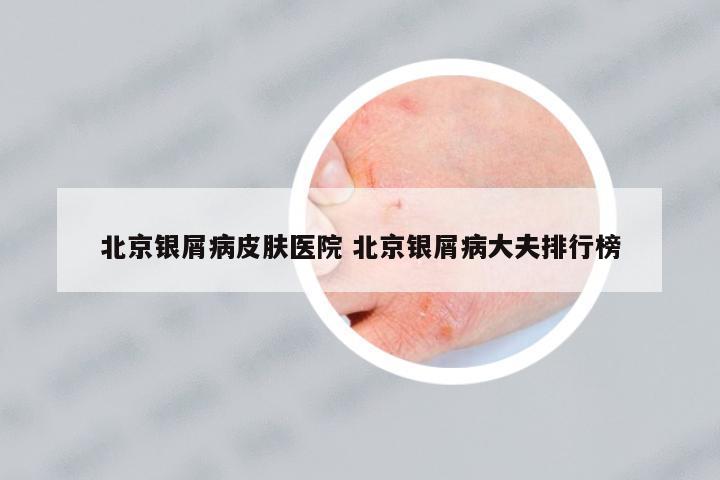北京銀屑病皮膚醫(yī)院 北京銀屑病大夫排行榜