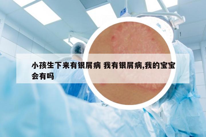小孩生下來有銀屑病 我有銀屑病,我的寶寶會有嗎