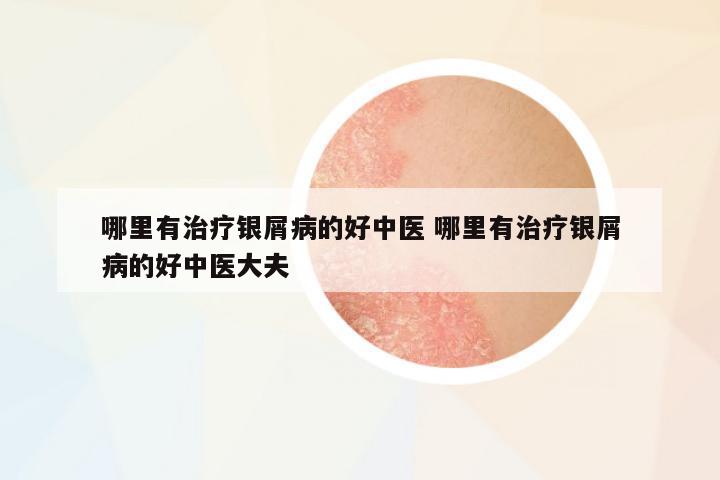 哪里有治療銀屑病的好中醫(yī) 哪里有治療銀屑病的好中醫(yī)大夫