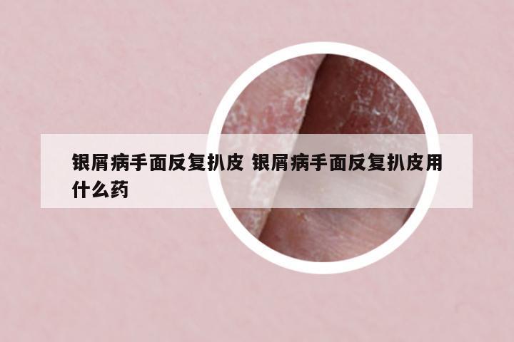 銀屑病手面反復扒皮 銀屑病手面反復扒皮用什么藥