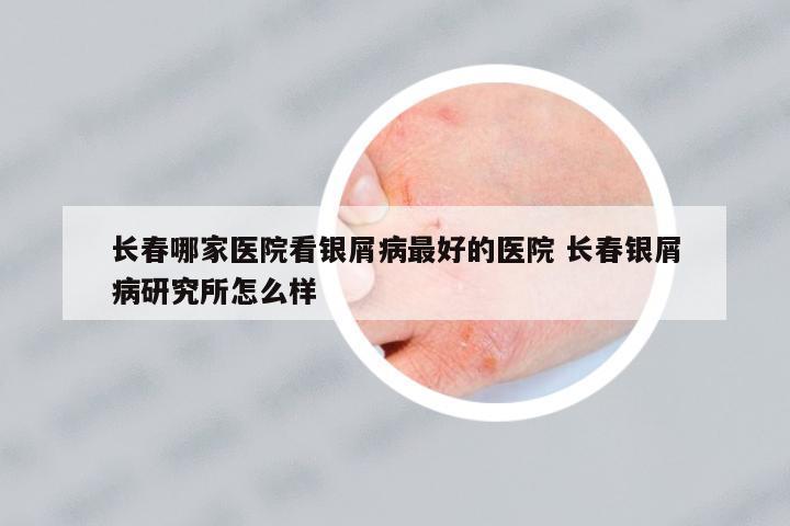 長春哪家醫(yī)院看銀屑病最好的醫(yī)院 長春銀屑病研究所怎么樣