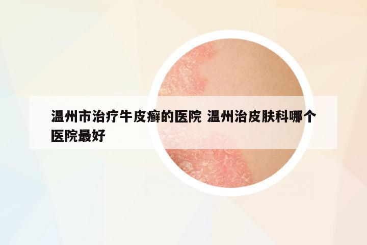 溫州市治療牛皮癬的醫(yī)院 溫州治皮膚科哪個醫(yī)院最好
