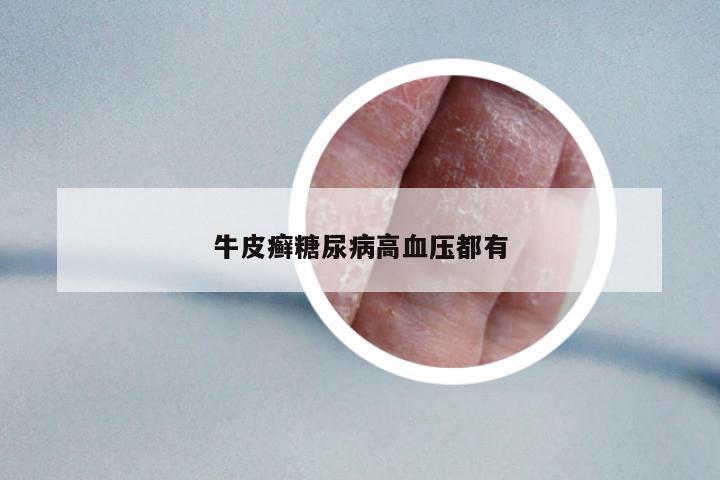牛皮癬糖尿病高血壓都有