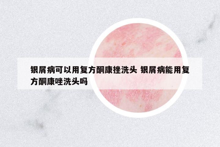銀屑病可以用復(fù)方酮康挫洗頭 銀屑病能用復(fù)方酮康唑洗頭嗎