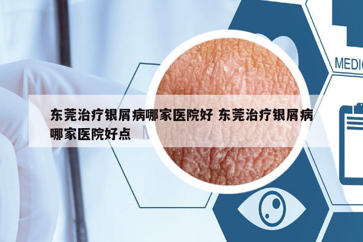東莞治療銀屑病哪家醫(yī)院好 東莞治療銀屑病哪家醫(yī)院好點(diǎn)