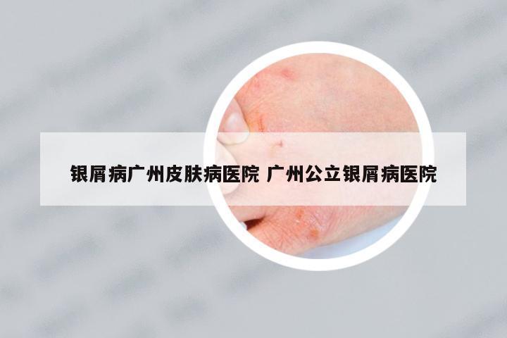 銀屑病廣州皮膚病醫(yī)院 廣州公立銀屑病醫(yī)院