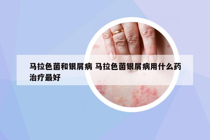 馬拉色菌和銀屑病 馬拉色菌銀屑病用什么藥治療最好