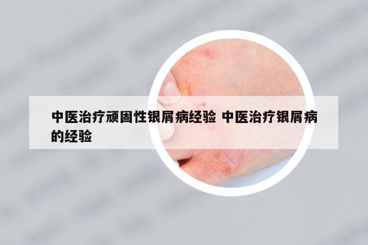 中醫(yī)治療頑固性銀屑病經(jīng)驗(yàn) 中醫(yī)治療銀屑病的經(jīng)驗(yàn)