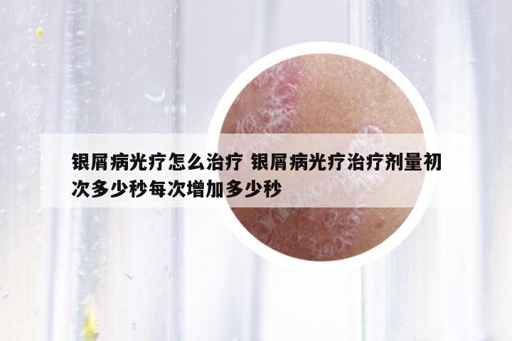 銀屑病光療怎么治療 銀屑病光療治療劑量初次多少秒每次增加多少秒