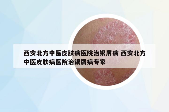 西安北方中醫(yī)皮膚病醫(yī)院治銀屑病 西安北方中醫(yī)皮膚病醫(yī)院治銀屑病專家