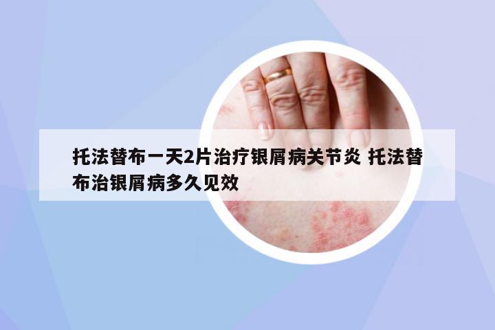 托法替布一天2片治療銀屑病關(guān)節(jié)炎 托法替布治銀屑病多久見效