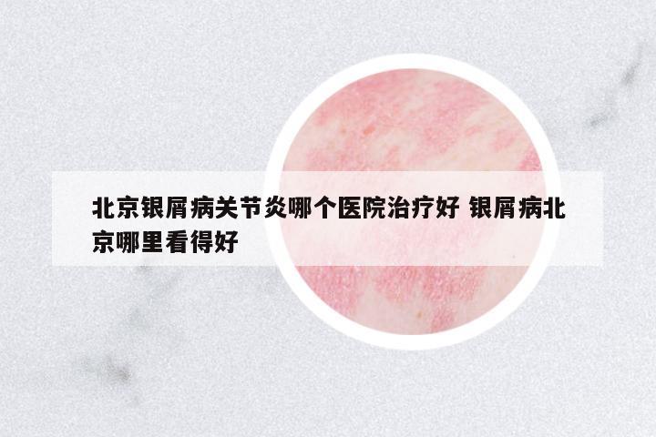北京銀屑病關(guān)節(jié)炎哪個(gè)醫(yī)院治療好 銀屑病北京哪里看得好