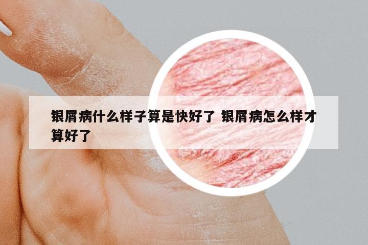 銀屑病什么樣子算是快好了 銀屑病怎么樣才算好了
