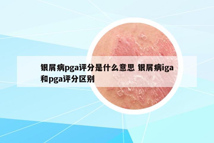 銀屑病pga評分是什么意思 銀屑病iga和pga評分區(qū)別