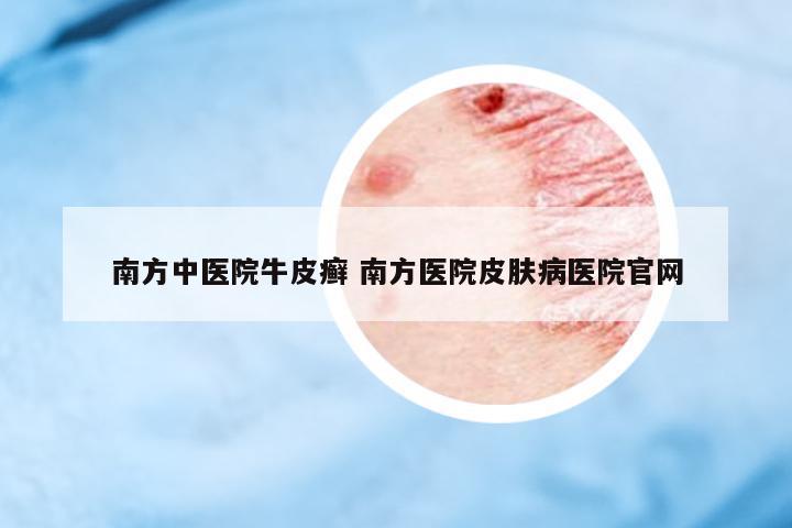 南方中醫(yī)院牛皮癬 南方醫(yī)院皮膚病醫(yī)院官網(wǎng)