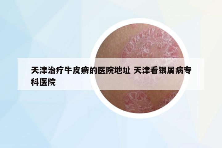 天津治療牛皮癬的醫(yī)院地址 天津看銀屑病??漆t(yī)院