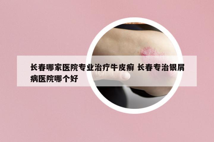 長春哪家醫(yī)院專業(yè)治療牛皮癬 長春專治銀屑病醫(yī)院哪個好